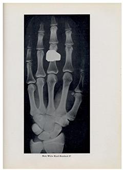 Atlas of Skeletal Maturation., written by T. Wingate Todd