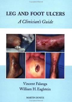 Leg and Foot Ulcers: A Clinician's Guide, written by William H Eaglstein; Vincent Falanga