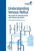 Read Understanding Venous Reflux the Cause of Varicose Veins and Venous Leg Ulcers: Varicose veins and venous leg ulcers (College of Phlebology), written by Mark S Whiteley