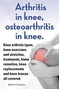 Read Arthritis in knee, osteoarthritis in knee. Knee arthritis exercises and stretches, treatments, home remedies, knee replacements and knee braces all covered., written by Robert Rymore